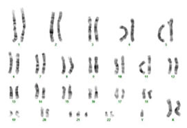 Double Aneuploidy in Down Syndrome (789)