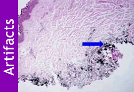 Artifacts in Histopathology: A Potential Cause of Misinterpretation (808)