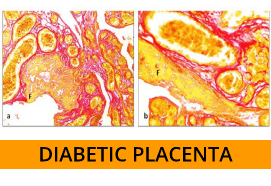 Histological Changes of the Placenta in Diabetes (819)