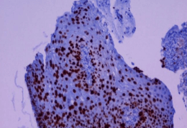 Ancillary Techniques in the Histopathologic Diagnosis of Cervical SIL & GIL (831)