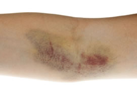 Patient Injuries Caused by Phlebotomy (858)