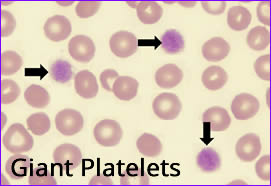 Bleeding Disorders Associated with Abnormal Platelets (975)