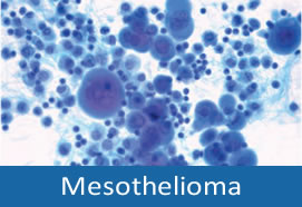 Mesothelioma: Overview of Technical, Immunochemical and Pathomorphological Aspects (1018)